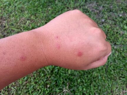 piqûre de frelon asiatique Guêpe que faire