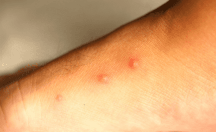 Piqûre punaise de lit