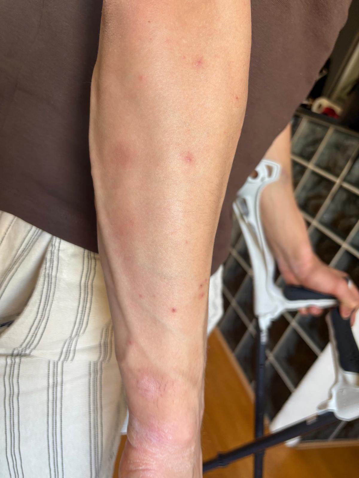 piqûre de punaise de lit